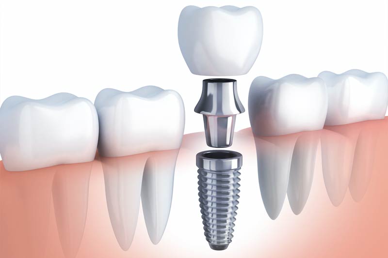 Implants Dentist in Rancho Bernardo
