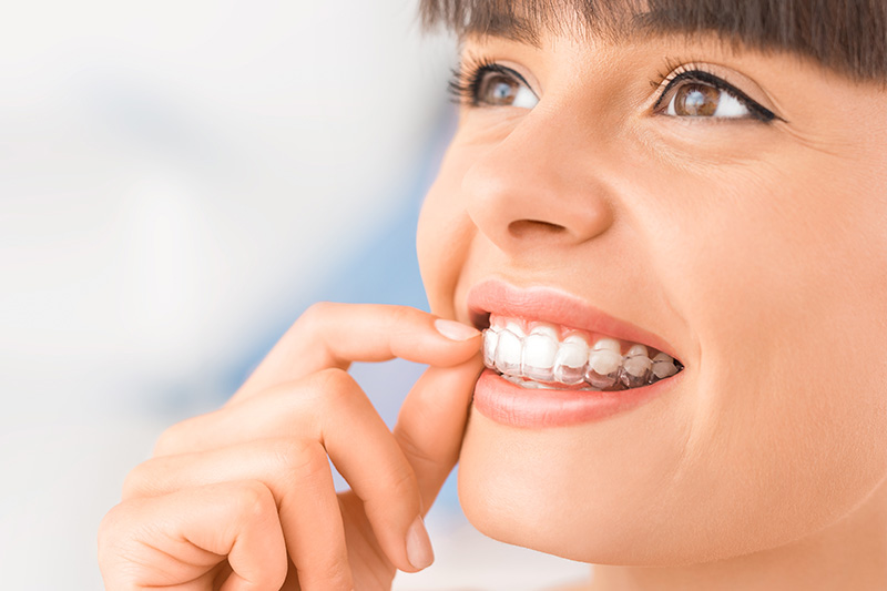 Invisalign in Rancho Bernardo