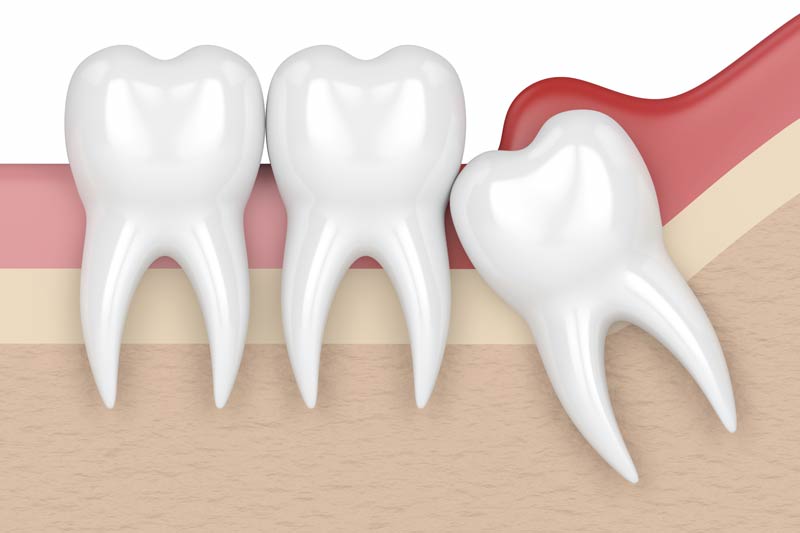 Wisdom Tooth Removal in Rancho Bernardo