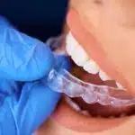 Invisalign