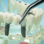 Dental Implants