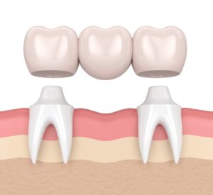 Dental Bridges