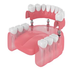 benefits of dental bridges
