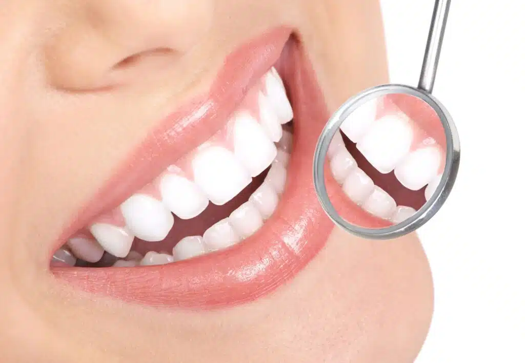 Teeth Whitening 