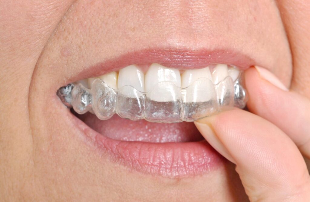 Benefits of Invisalign for Adults and Teens