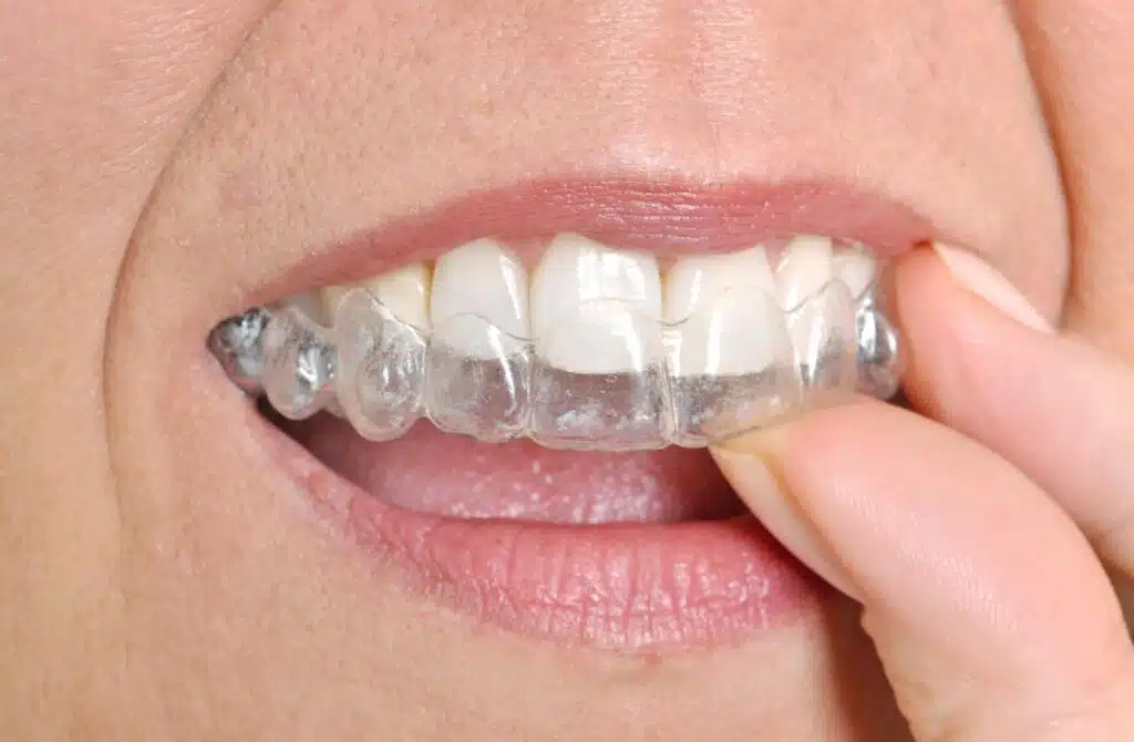 Benefits of Invisalign for Adults and Teens