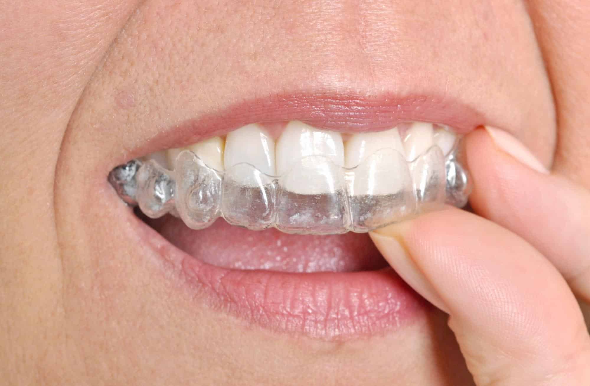 Benefits of Invisalign for Adults and Teens