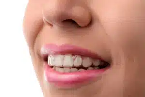 Health Benefits of Invisalign for Better Oral Care